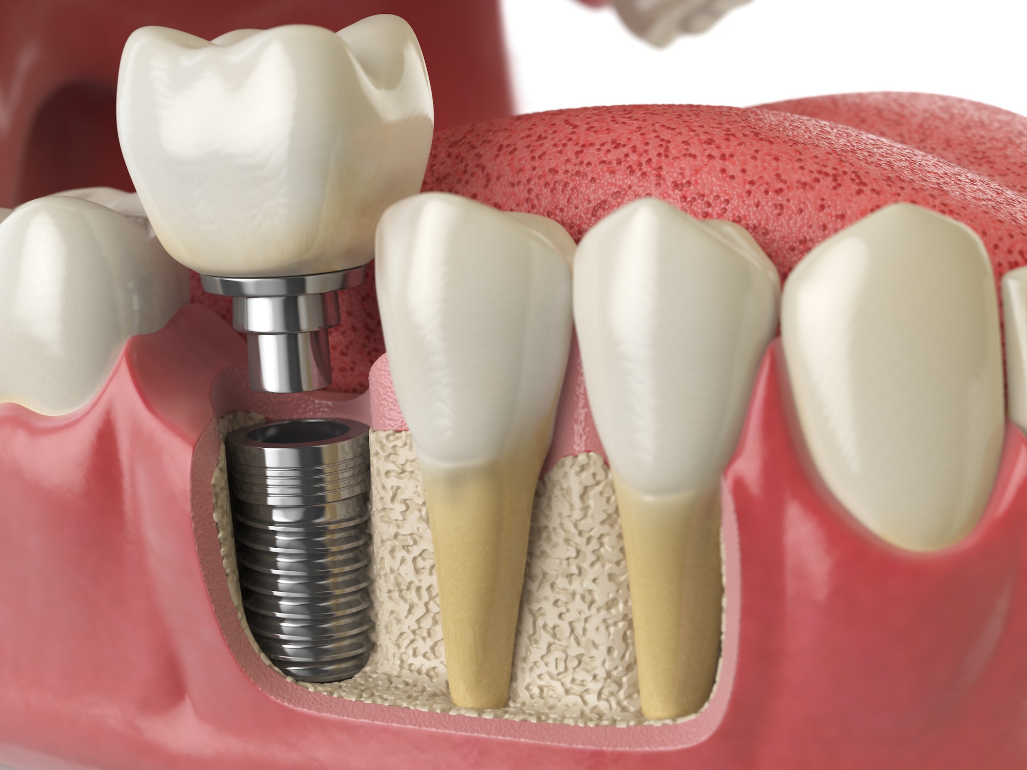 Dental Implants A Permanent Solution For Missing Teeth